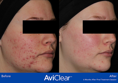 AviClear for Acne