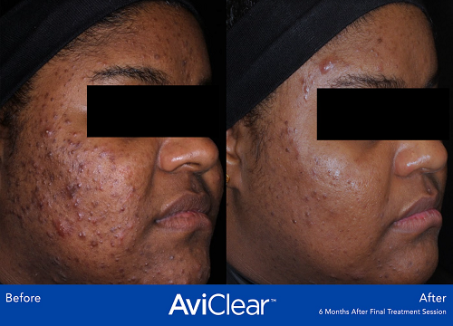 AviClear for Acne